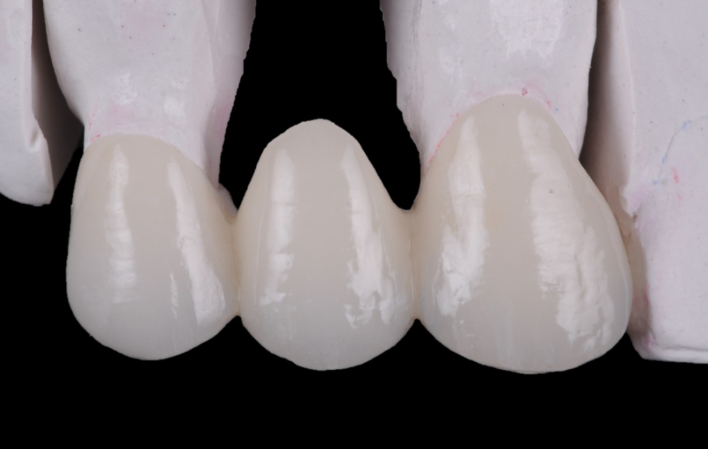 Bridge - Lab Photo 1 - Palmetto Prosthodontics - Esthetic Dentistry and ...